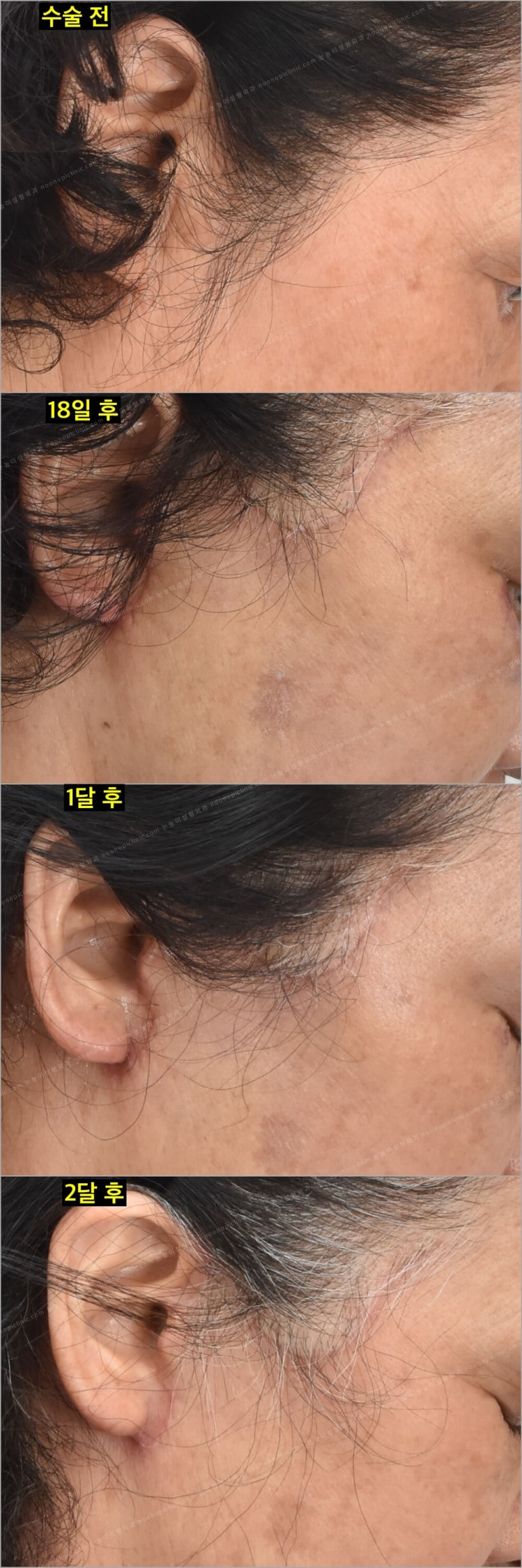 Facelift Scars and Recovery Time image 24