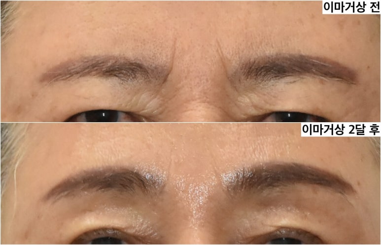이마거상 이마주름과 미간주름 얼마나 좋아질까 관련 이미지 2