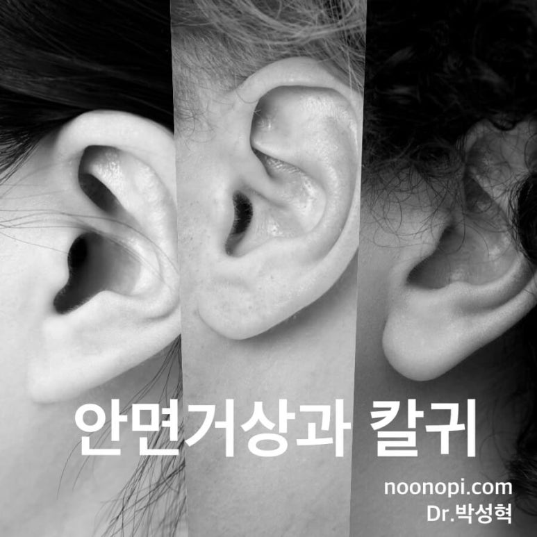 안면거상은 하고 싶은데 칼귀가 될까 봐 두려우셨나요? 관련 이미지 1