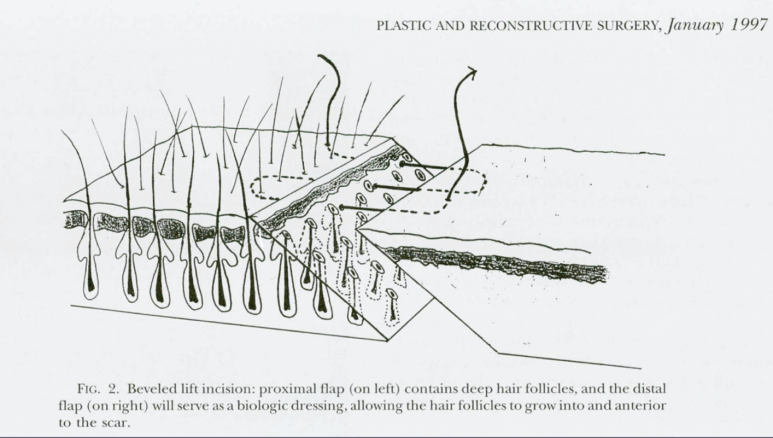 Forehead Reduction Surgery vs Hair Transplant image 11
