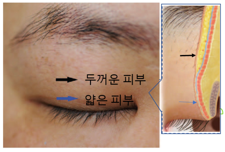 Creating Double Eyelids: What to Know If You’ve Been Using Tape and Eventually Decide on Surgery image 3