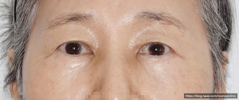 가족에게 추천한 눈밑하안검수술 24개월 경과 관련 이미지 9