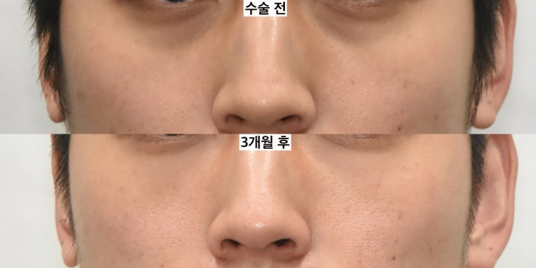 눈밑지방이식은 어떤 경우 하는 게 좋을까 관련 이미지 3