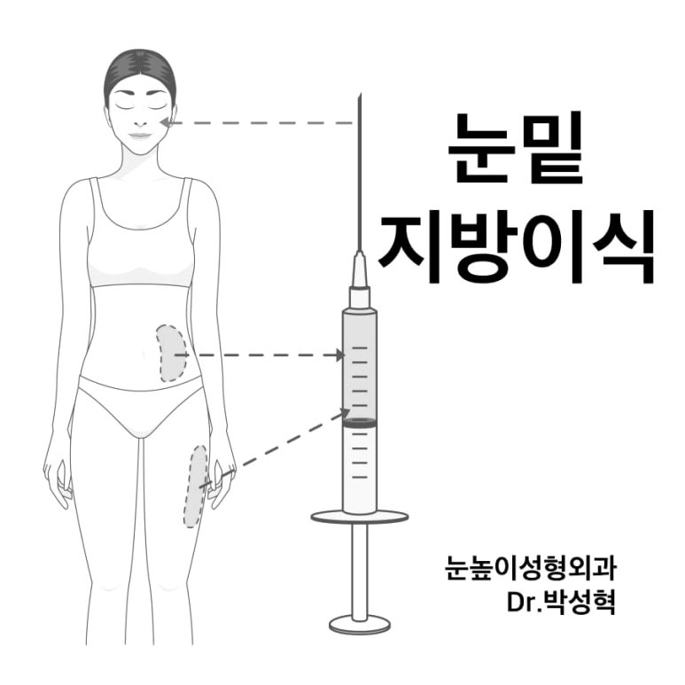 눈밑지방이식 어떤 경우에 효과적일까? 과도함, 부작용 방지 위해 관련 이미지 1