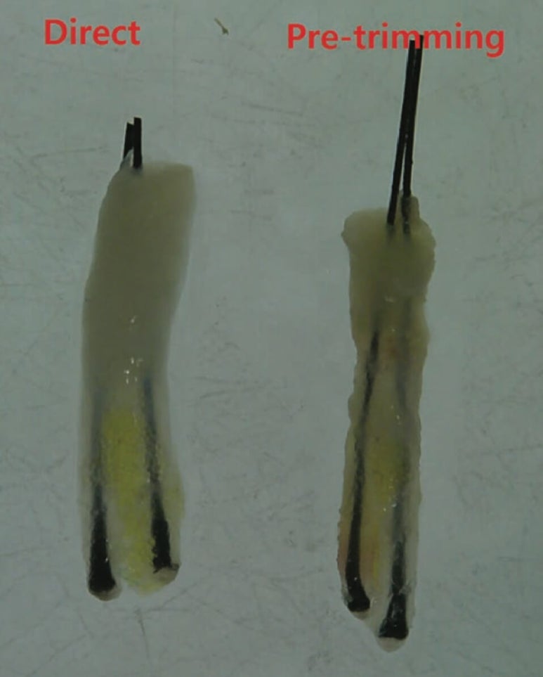 Forehead Reduction Surgery vs Hair Transplant image 19