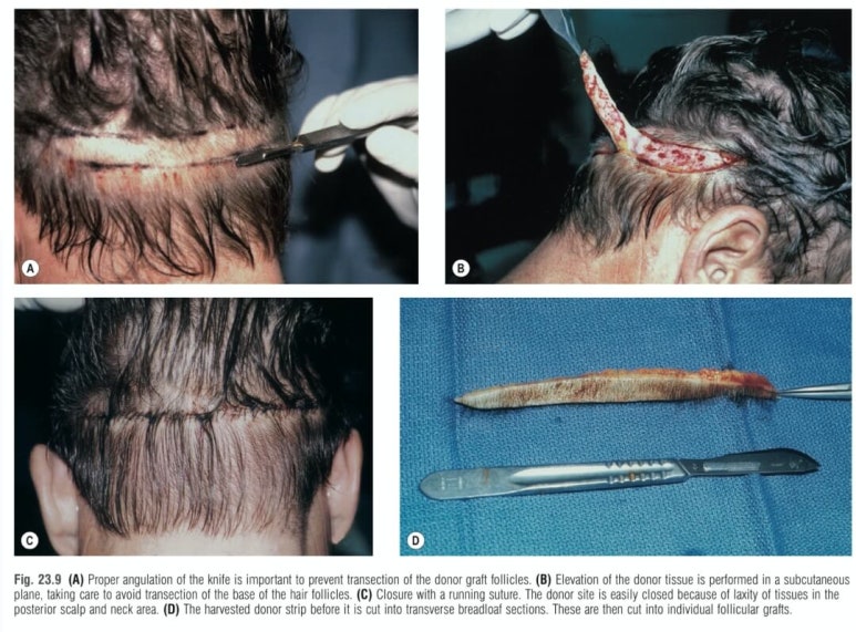 Forehead Reduction Surgery vs Hair Transplant image 17