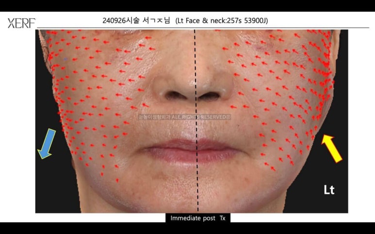 안면거상 후 세르프 리프팅은 언제부터 가능할까 관련 이미지 7
