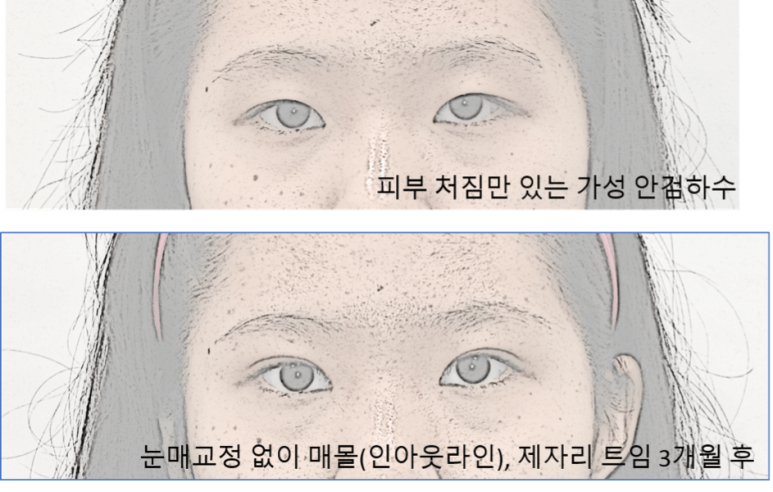 눈매교정과 쌍수 중 나에게 최선은? 관련 이미지 3