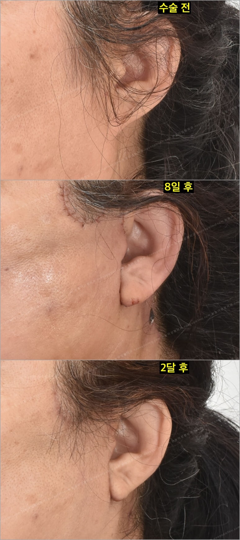Facelift Scars and Recovery Time image 12