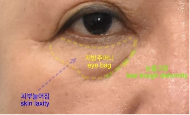 40대 눈밑지방재배치술 효과, 경과 관련 이미지 2