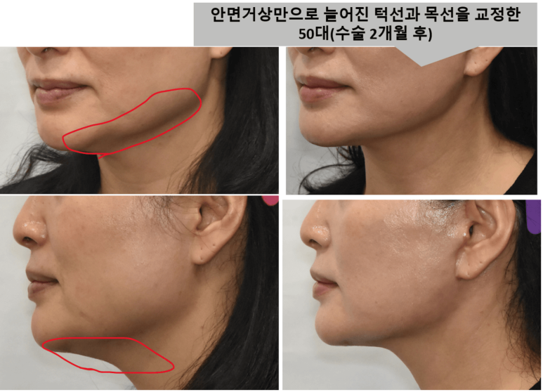 이중턱 치료 : 목거상술의 실제 효과는? 관련 이미지 2