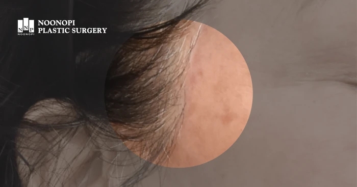 남자 안면거상술, 머리카락 없는데 흉터는 어떡하죠? 관련 이미지 10