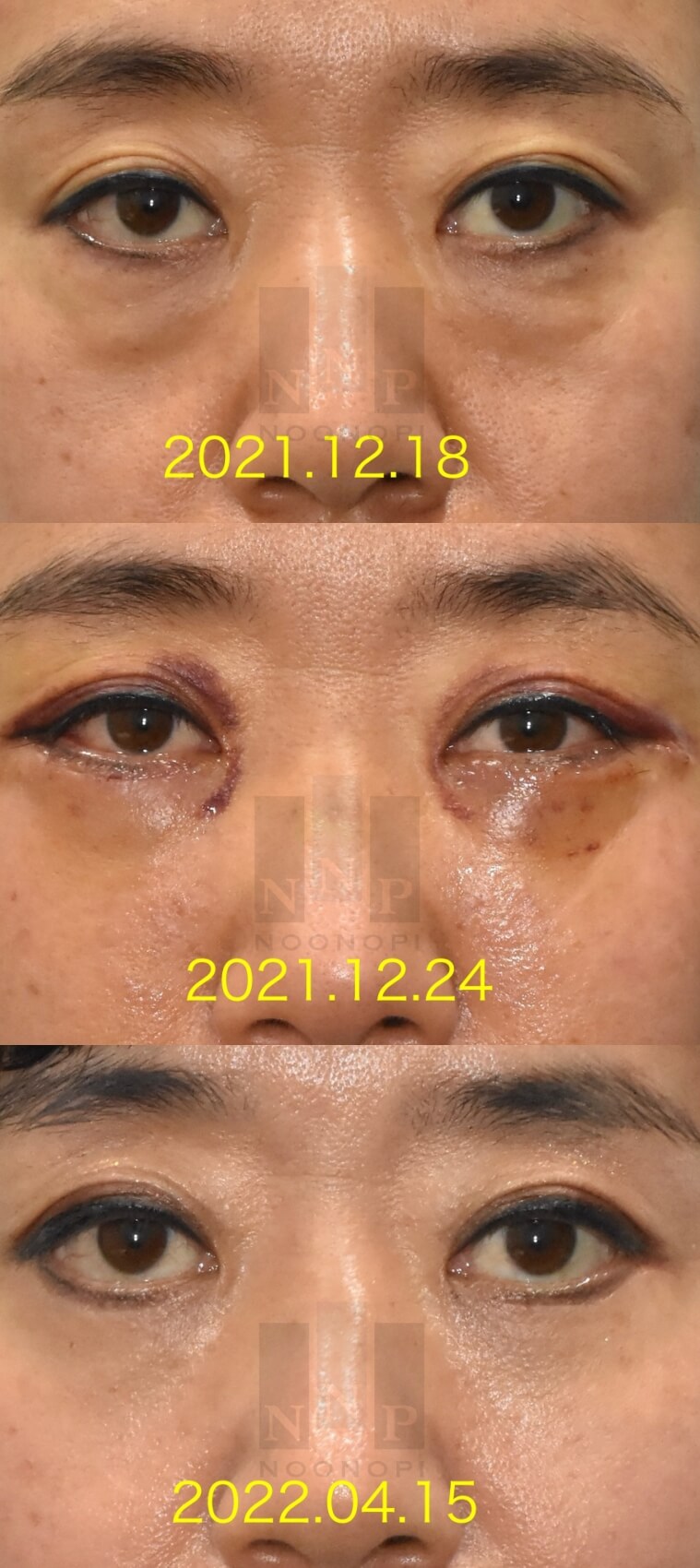 Lower Blepharoplasty vs. Fat Repositioning for Under-Eye Bags - Which Under-Eye Surgery Is Right for Me? image 11