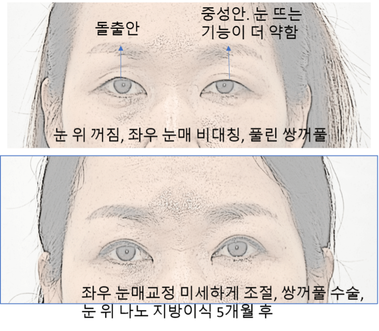 눈매교정과 쌍수 중 나에게 최선은? 관련 이미지 6