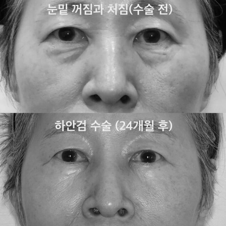 하안검수술 부작용 예방과 대처 방법 관련 이미지 1