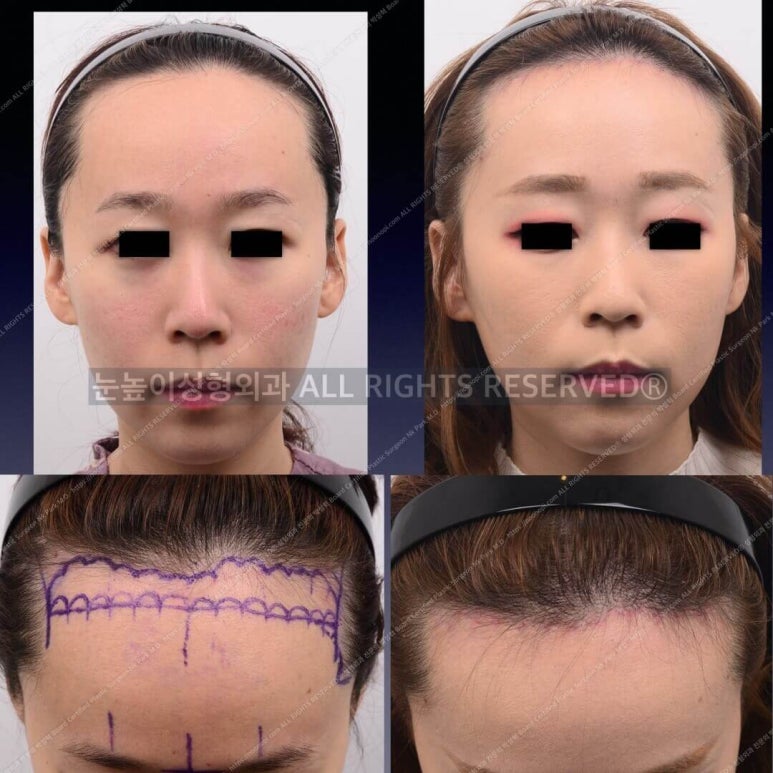 Forehead Reduction Surgery vs Hair Transplant image 9