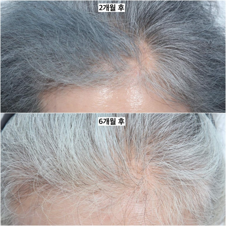 Brow Lift Scars and Hair Loss image 5