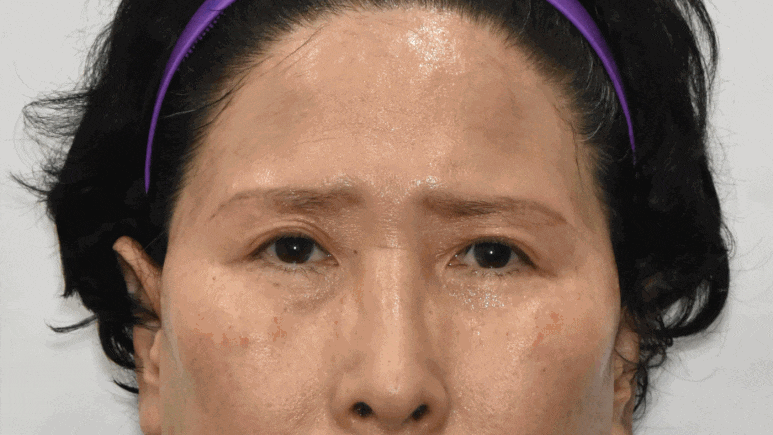 중년 눈수술! 사나워지자고 하는게 아니잖아요 :  조영구 성형에 관한 눈높이성형외과의 견해 관련 이미지 3