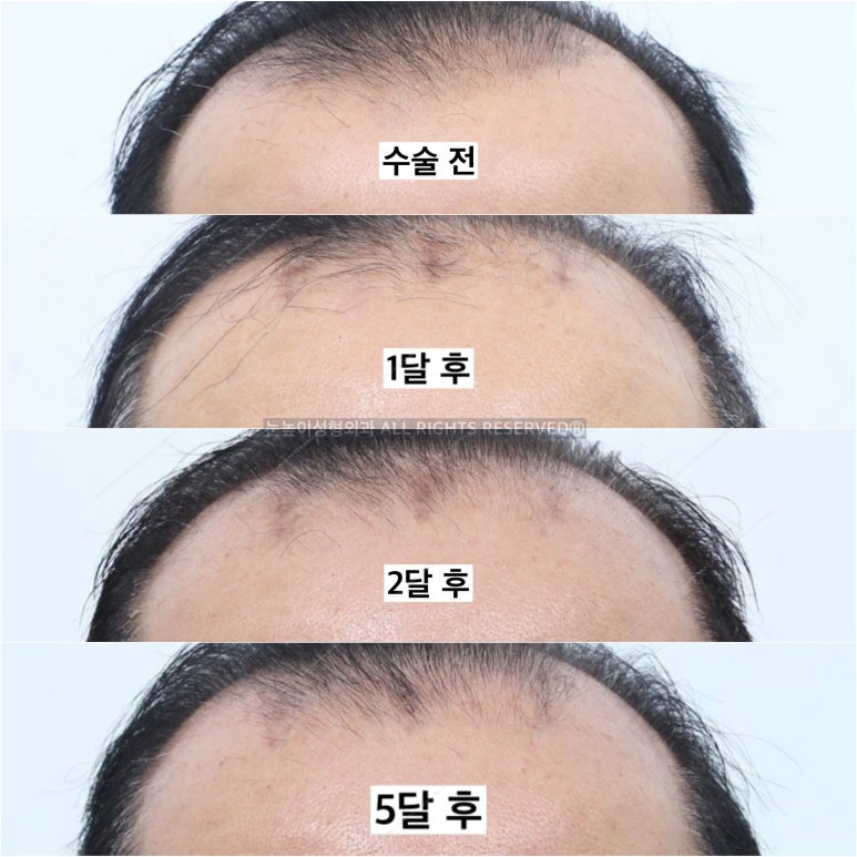 이마거상 비용과 부작용, 회복 과정에 대하여 관련 이미지 11