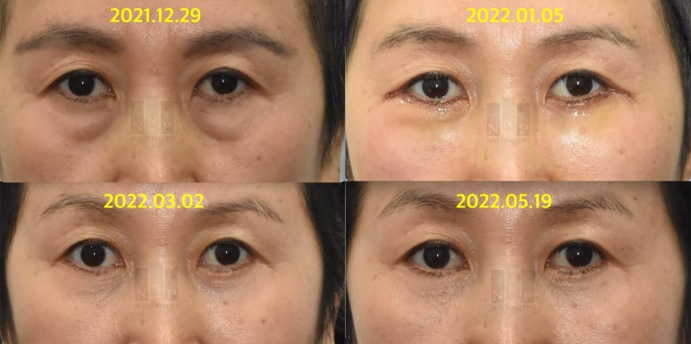 Lower Blepharoplasty vs. Fat Repositioning for Under-Eye Bags - Which Under-Eye Surgery Is Right for Me? image 5