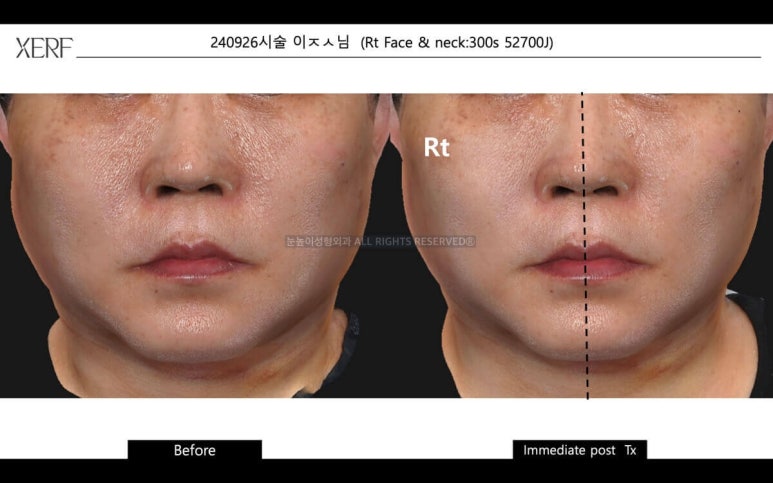 안면거상 후 세르프 리프팅은 언제부터 가능할까 관련 이미지 8