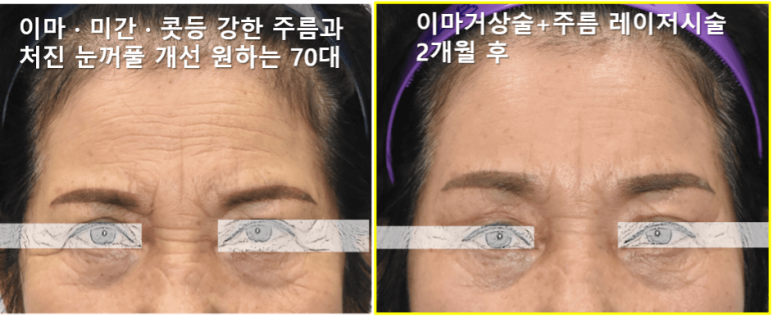 [Case Report] In What Cases Is Endoscopic Forehead Lift Performed? How Does It Change? (feat. High-Level Aftercare) image 3
