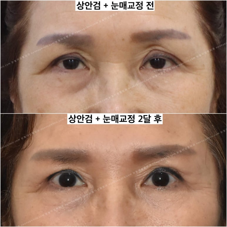 상안검수술하려는데 안검하수가 웬 말? 관련 이미지 10