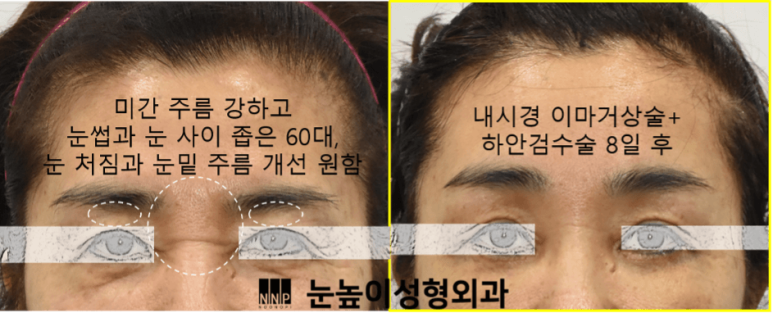 [Case Report] In What Cases Is Endoscopic Forehead Lift Performed? How Does It Change? (feat. High-Level Aftercare) image 2