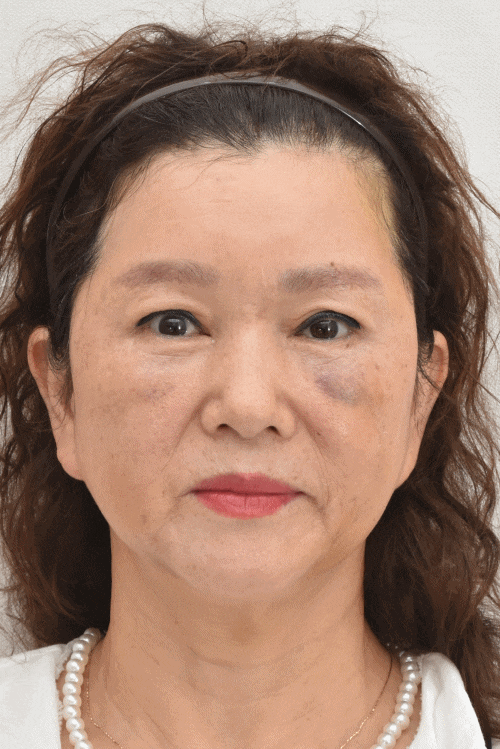 상안검수술하려는데 안검하수가 웬 말? 관련 이미지 14
