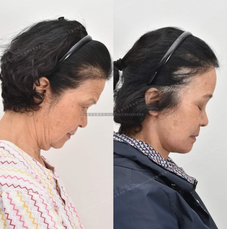 성형외과에서는 이중턱 리프팅을 이렇게 권한다(목거상수술) 관련 이미지 12