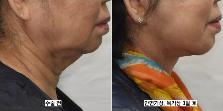 세상에서 가장 안면거상 수술을 잘하는 닥터 관련 이미지 8