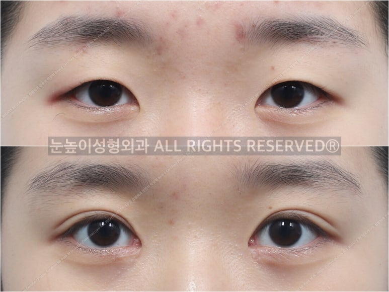 성형외과 전문의가 말하는 아름다운 눈이란 관련 이미지 11