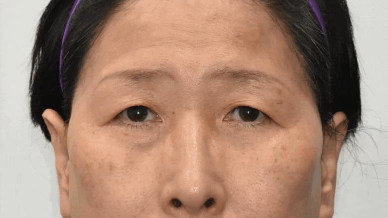 중년 눈수술! 사나워지자고 하는게 아니잖아요 :  조영구 성형에 관한 눈높이성형외과의 견해 관련 이미지 2