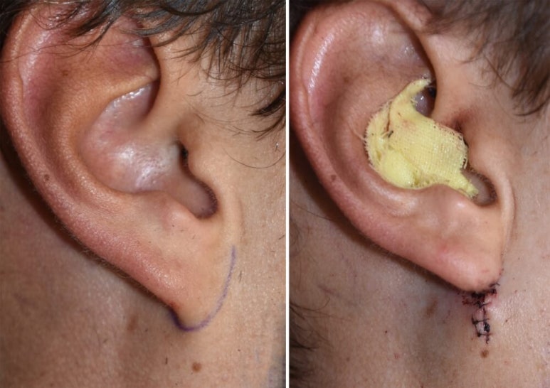 Facelift Scars and Recovery Time image 17