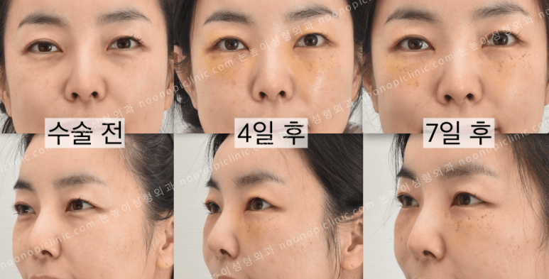 Were you curious about swelling and recovery after lower blepharoplasty? image 10