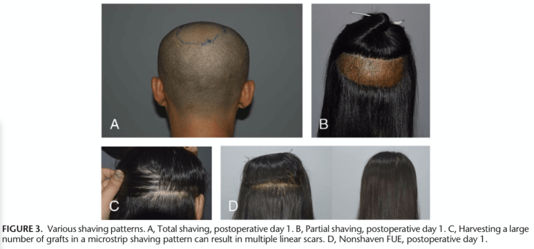 Forehead Reduction Surgery vs Hair Transplant image 18