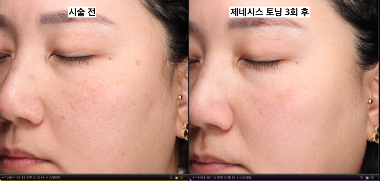 토닝 레이저 한 번으로 기미가 얼마나 좋아질까? 관련 이미지 9