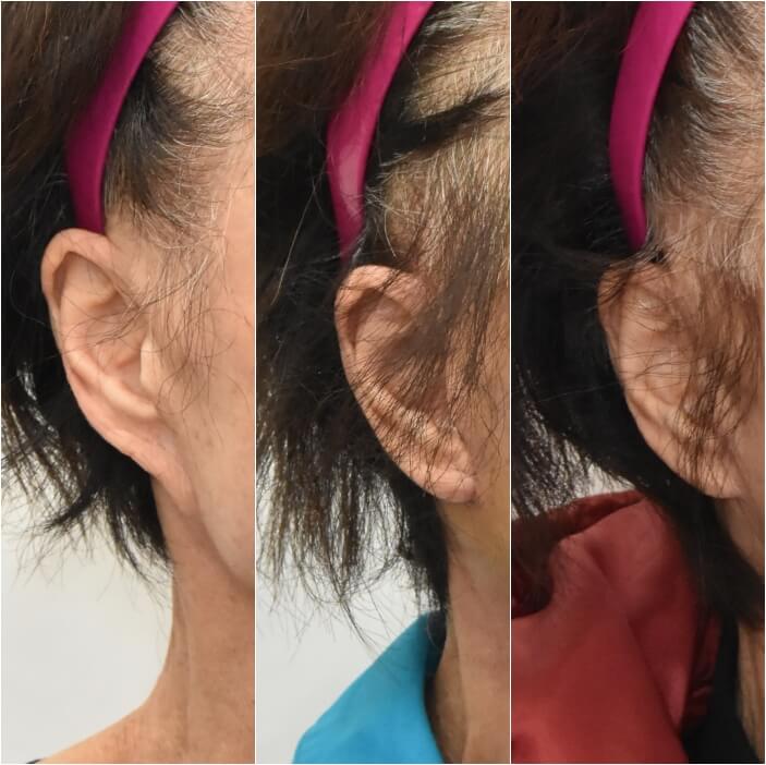안면거상은 하고 싶은데 칼귀가 될까 봐 두려우셨나요? 관련 이미지 3