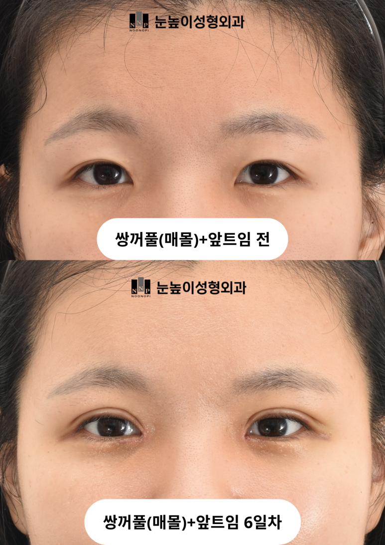 If You're Worried About Inflammation After Summer Plastic Surgery image 7