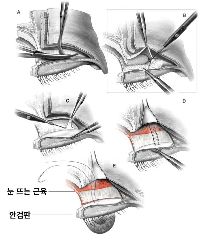 상안검수술하려는데 안검하수가 웬 말? 관련 이미지 7