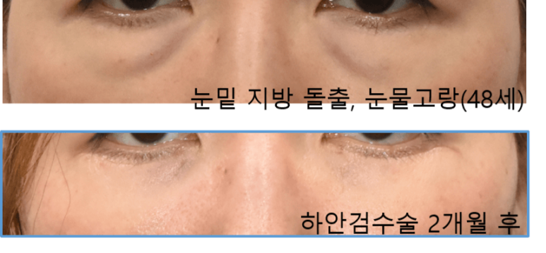 40대 눈밑지방재배치술 효과, 경과 관련 이미지 6