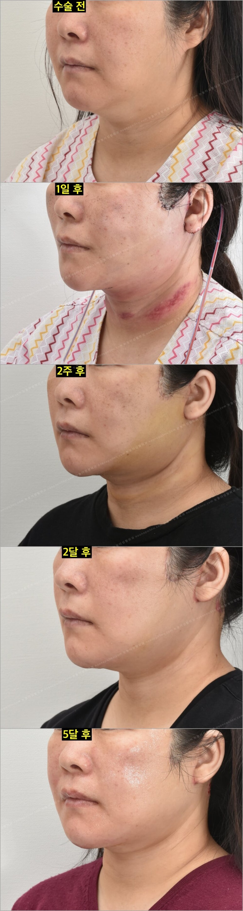 Facelift Scars and Recovery Time image 4