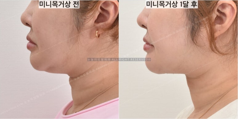 성형외과에서는 이중턱 리프팅을 이렇게 권한다(목거상수술) 관련 이미지 14