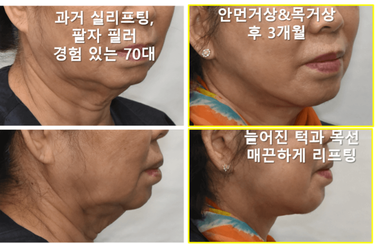 안면거상술 생각하는데 부작용 걱정 되세요? 관련 이미지 6