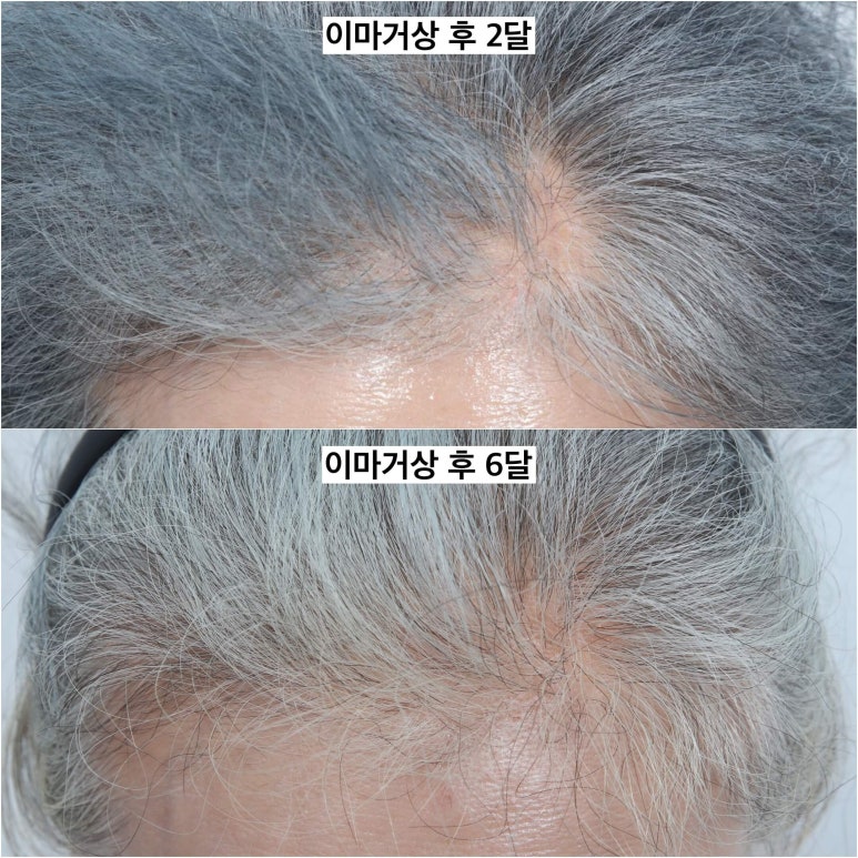 이마거상 비용과 부작용, 회복 과정에 대하여 관련 이미지 8