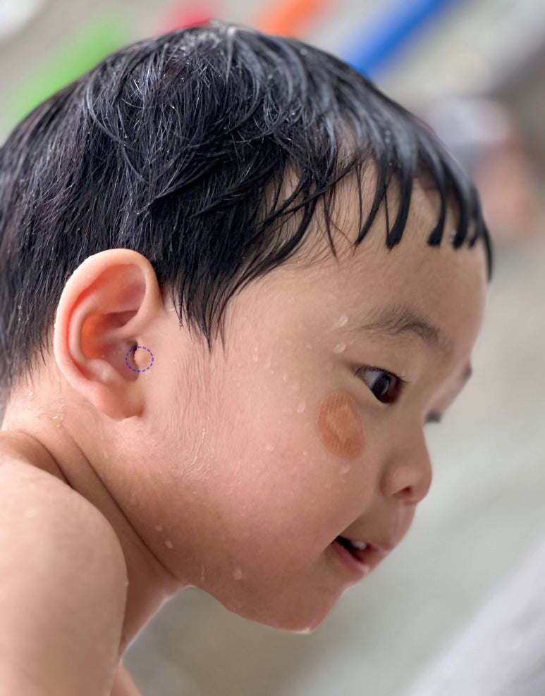 Facelift Scars and Recovery Time image 19