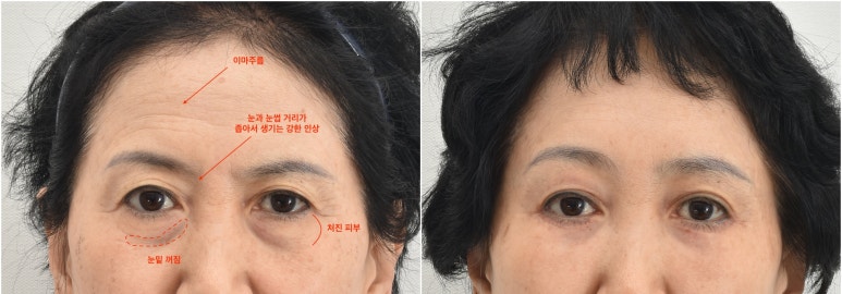 If You’re Looking Into Cosmetic Surgery as a Mother’s Day Gift for Your Parents image 7
