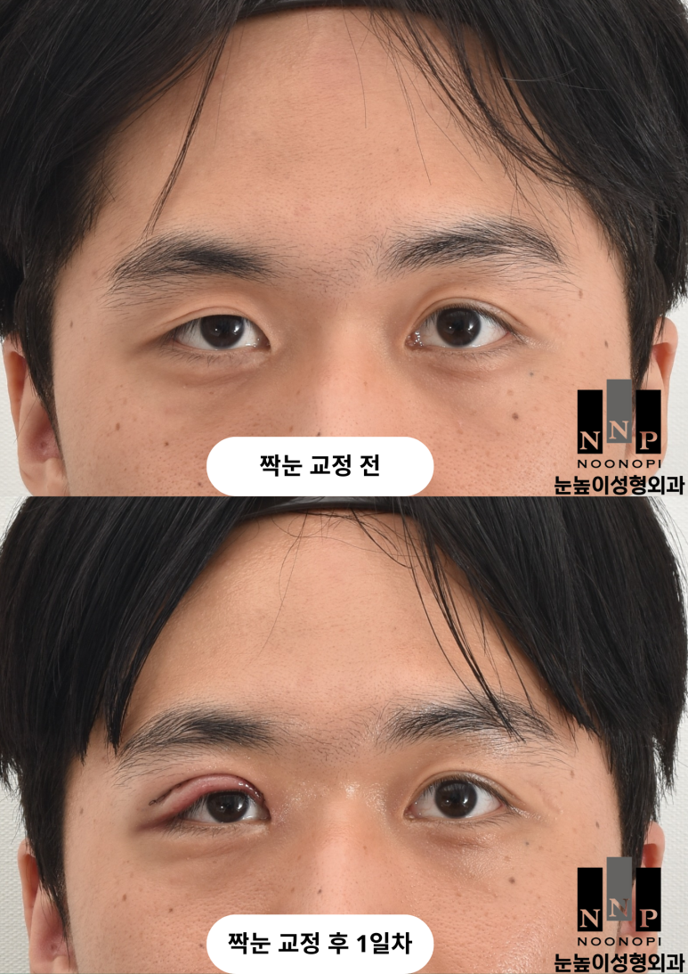If You're Worried About Inflammation After Summer Plastic Surgery image 8