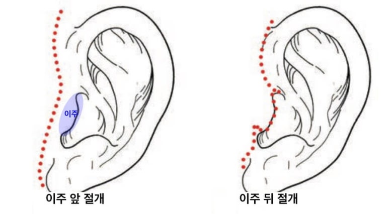 안면거상에서 시행하는 절개 위치는? 관련 이미지 5