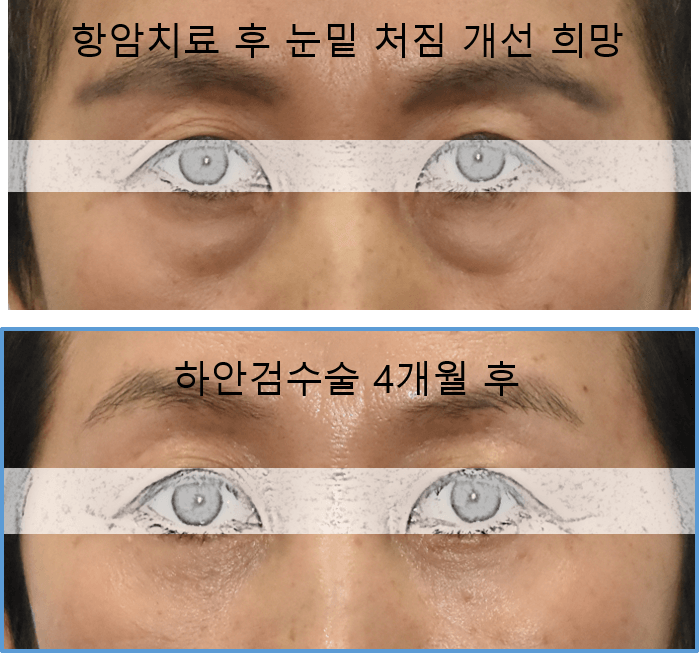 하안검수술 부작용 예방과 대처 방법 관련 이미지 5